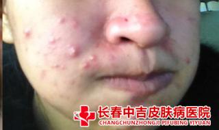治疗痤疮最好的医院 治疗痤疮最好的医院